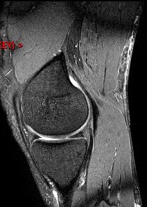 Figure 3 for case Semitendinosus tendon tear, retracted( RID2717 )